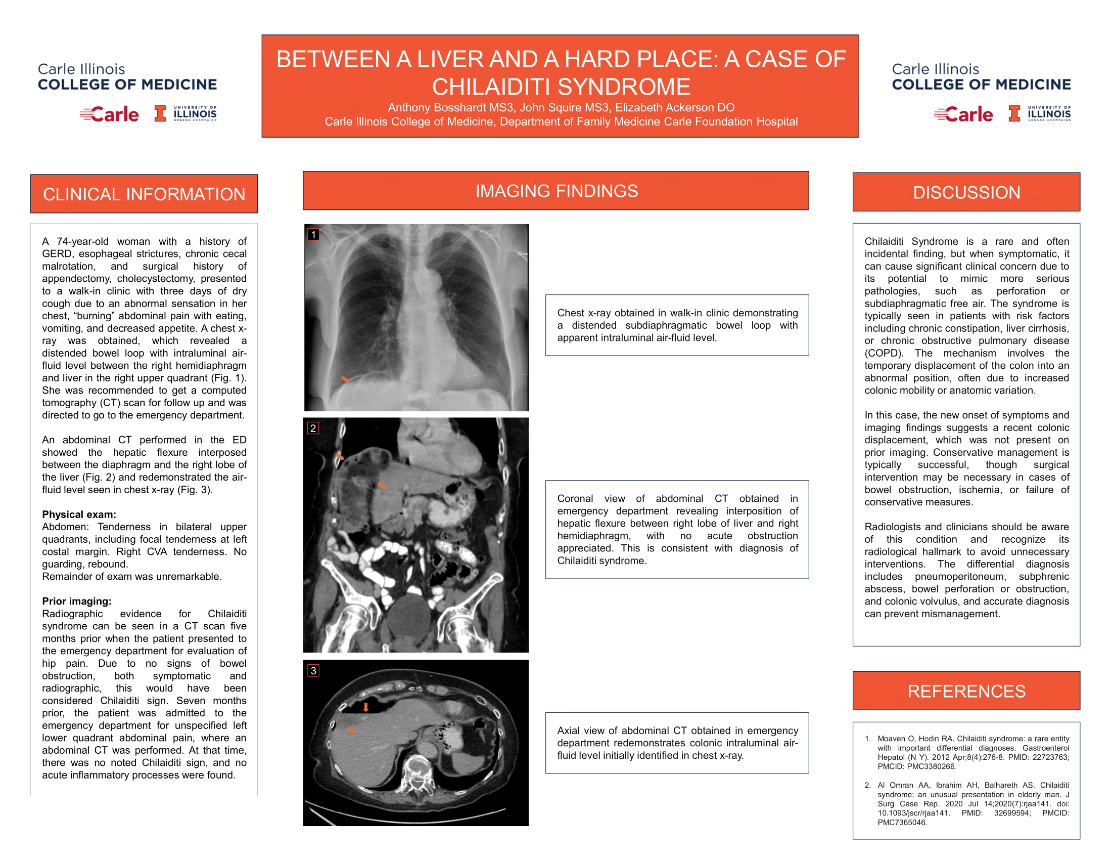 Between a Liver and a Hard Place: A Case of Chilaiditi Syndrome